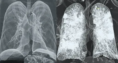 Рентген или флюорография легких? – статья в блоге Медскан