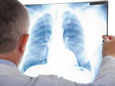 Рентген легких - норма или нет? | Портал радиологов