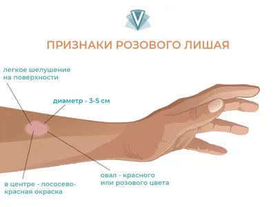 Лечение розового лишая (лишая Жибера) в Киеве — Derma.ua