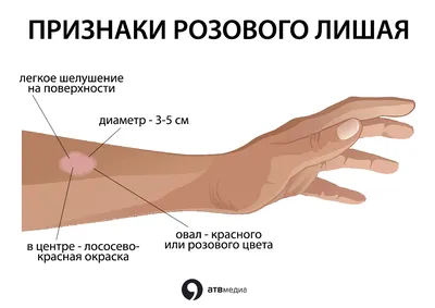 Способы лечения красного плоского лишая — блог медицинского центра ОН Клиник