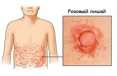 Лишай у человека на лице и теле | симптомы, причины, диагностика и лечение