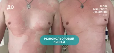 Розовый лишай Жибера: лечение в Brenner Clinic (Киев)