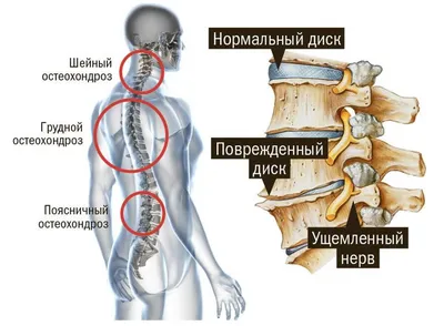 Остеохондроз позвоночника: причины, симптомы, стадии, лечение, профилактика