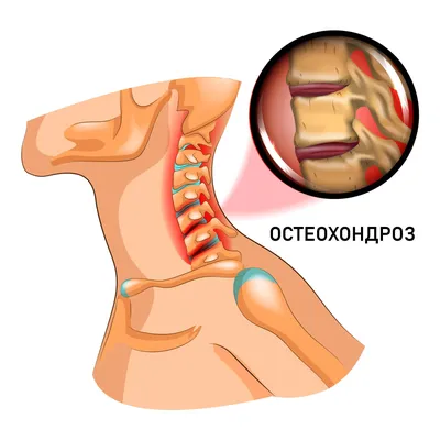 Остеохондроз шейного отдела: причины, симптомы, как избавиться, лечение