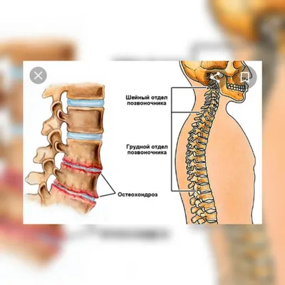 Шейный остеохондроз — это заболевание межпозвоночных дисков шейного отдела  позвоночника. Болезнь достаточно опасна, и нужно знать как… | Instagram