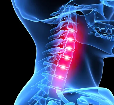 Признаки и симптомы шейного остеохондроза - Доктор Позвонков