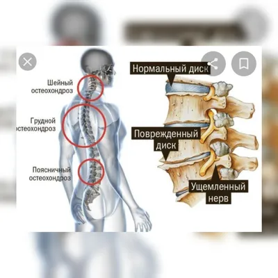 Шейный остеохондроз: симптомы и лечение | Клиника Temed