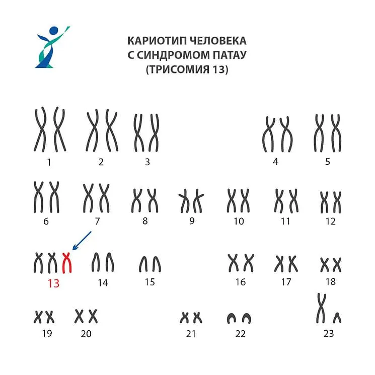 Синдром патау хромосомы. Синдром Патау (трисомия 13-й хромосомы). Синдром Патау трисомия 13. Синдром Патау генетика.