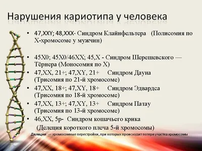 Презентация на тему: \"Синдром Эдвардса Подготовила: студентка 5 курса, ІІІ  медицинского факультета,4й группы Потихенская К.\". Скачать бесплатно и без  регистрации.