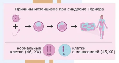 СИНДРОМ ШЕРЕШЕВСКОГО—ТЕРНЕРА ⠀ 📕Впервые эта болезнь как наследственная  была описана в 1925 г. Н.А. Шерешевским, который считал, что она… |  Instagram