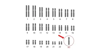 Синдром Шерешевского-Тернера: признаки, методы диагностики, профилактика,  этиология