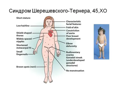 Синдром Шерешевского - Тернера | Справка.Неинвалид.ru