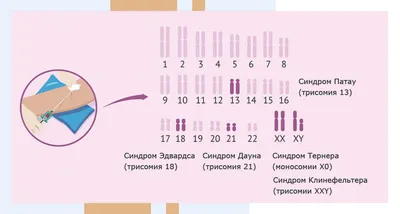 Мозаичный вариант синдрома Тернера uMEDp