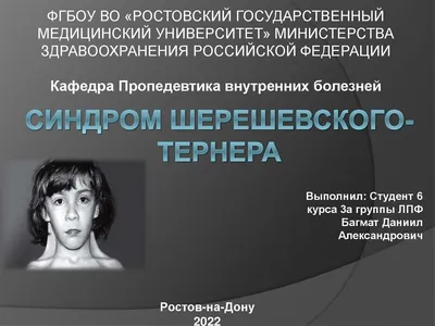 Синдром Шерешевского-Тёрнера и потеря слуха | Здоровый слух | Дзен