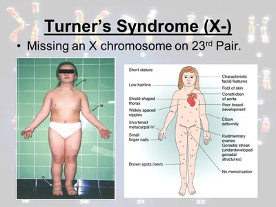 Синдром Шерешевского — Тёрнера: причины, симптомы и лечение в статье  детского эндокринолога Кокорева К. Д.
