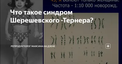 Синдром Шерешевского-Тёрнера — [моносомия X-хромосомы XО] — причины,  симптомы, даигностика, лечение - YouTube