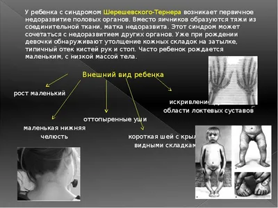 Синдром Турнера, лечение в Москве