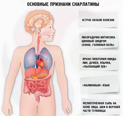 MedHelper - СКАРЛАТИНА-это опасное инфекционное заболевание, вызванное  Стрептококком А. Чаще всего болеют дети. Если Ваш ребенок был в контакте с  больным скарлатиной, важно знать следующее. Скарлатина имеет 3 основных  симптома: 1.Боли в