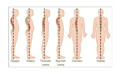 Прием ортопедов сколиоз - Ортотис Премиум