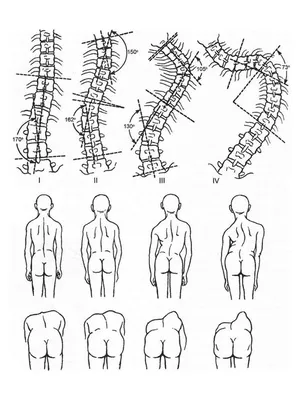 Сколиоз, виды искривления позвоночника у детей и взрослых, лечение сколиоза  в Москве