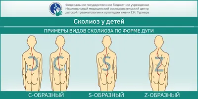 Степени сколиоза. Симптомы и диагностика сколиоза на разных стадиях