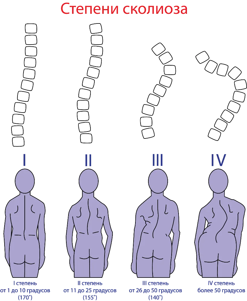 Сколиоз 1 степени категория годности. Рекомендации болеющим сколиозом. Колит в ребрах из за искривления позвоночника. Асимметрия груди из за сколиоза.