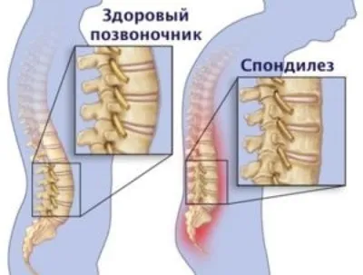 Спондилез - признаки, причины, симптомы, лечение и профилактика - iDoctor.kz