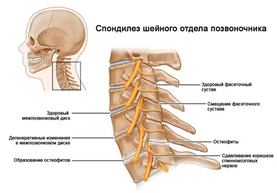 Деформирующий спондилез: лечение — International Lumbago Clinic