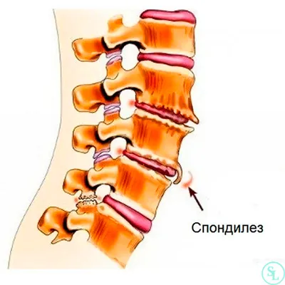 Спондилез позвоночника поясничного, грудного и шейного отдела - лечение и  симптомы