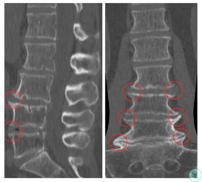 Спондилез грудного отдела позвоночника: особенности и деформирующий  характер заболевания