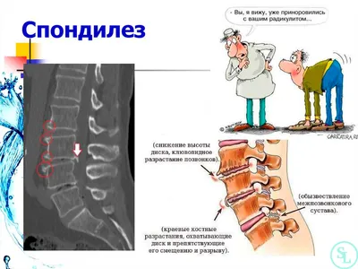 Спондилез позвоночника поясничного, грудного и шейного отдела - лечение и  симптомы