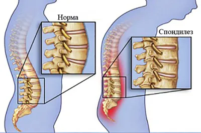 Лечение спондилеза | Блог