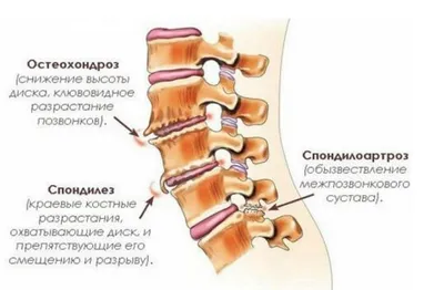 Спондилез и спондилоартроз позвоночника