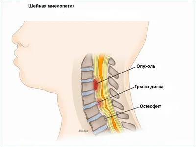 Спондилез: симптомы, причины, лечение брекетами