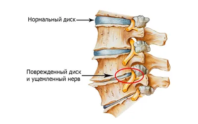 Спондилез (артроз межпозвонковых суставов) - найти специалиста | Leading  Medicine Guide