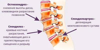 Как лечить спондилез