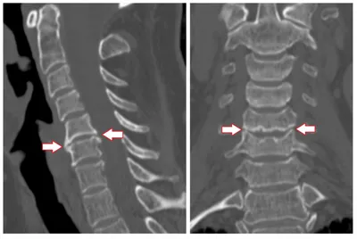 Комбинированный спондилез при травматических повреждениях позвоночника |  Meddoc