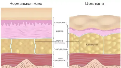 evgeniyapribytkova85 - Привет, мои дорогие! 😘😘😘⠀ Сегодня я расскажу о  том, какие стадии целлюлита бывают, и как они проявляются. 🤔 ⠀ ⠀ Всего  выделяют 4 стадии: ⠀ ° первая стадия обусловлена отеком (