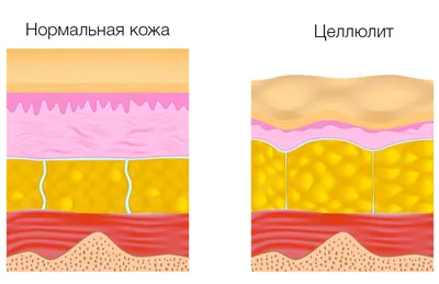 Как убрать целлюлит: 11 эффективных способов | Европейские курсы массажа