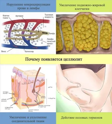 Целлюлит: стадии и способы борьбы