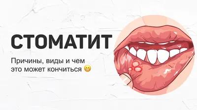 Стоматит – что это, виды, симптомы, лечение у взрослых в «Стоматологии  Комфорта»