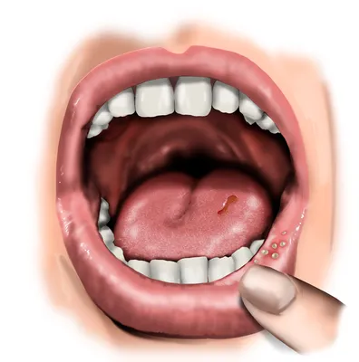 Герпетический стоматит. Этиология, патогенез, клиника