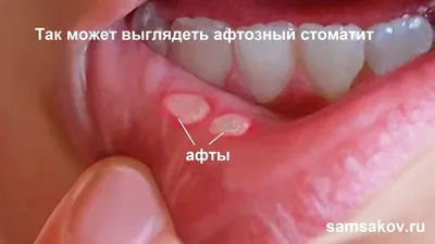 Стоматит у ребенка: симптомы, причины и лечение