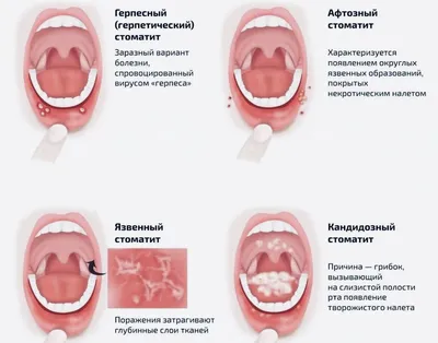 Стоматит у ребенка: лечение, допустимые препараты, симптомы, признаки,  профилактика в домашних условиях