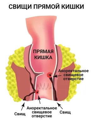 Киста копчика лечение при нагноении операция - YouTube