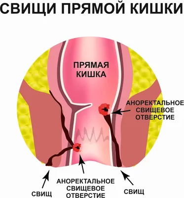 Чем опасна киста копчика? | Медицинский центр «АТЛАНТиК» | Дзен