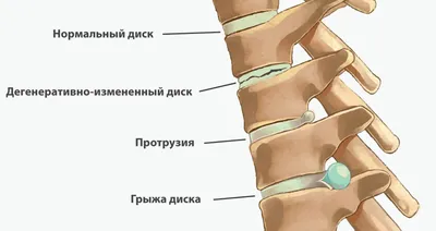 ☰ Киста копчика ᐈ Операция — Цена в МЦ Медиленд