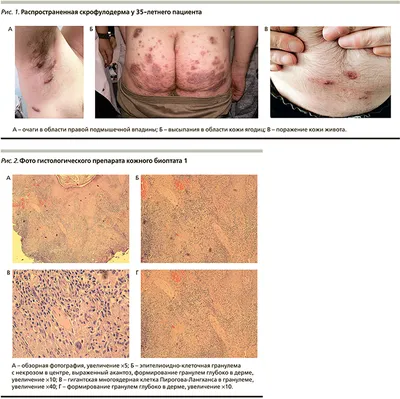 [75+] Туберкулез кожи картинки обои