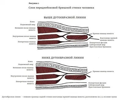 Упражнения при диастазе прямых мышц живота