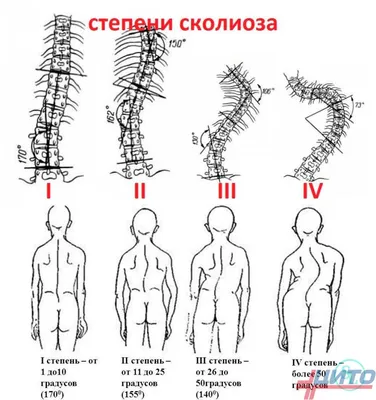 Бубновский упражнения для позвоночника: упражнения при кифозе и лордозе -  YouTube